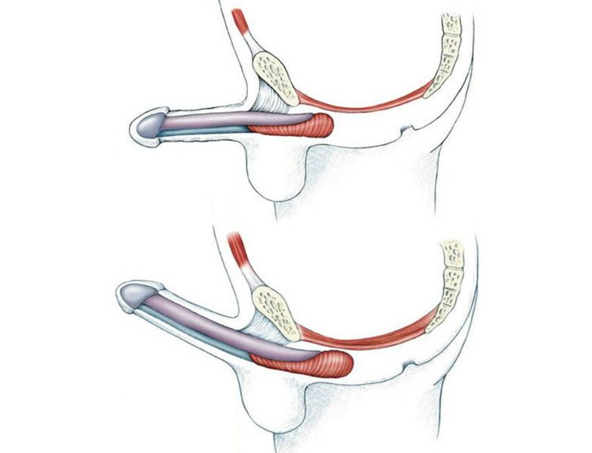 Erekcija muškarca prije i poslije treninga mišića dna zdjelice